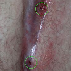 Click image for larger version

Name:	230px-Two_pilonidal_cysts_in_the_natal_cleft.jpg
Views:	1
Size:	10.7 KB
ID:	89734